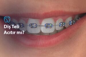 Diş Teli Acıtır mı?