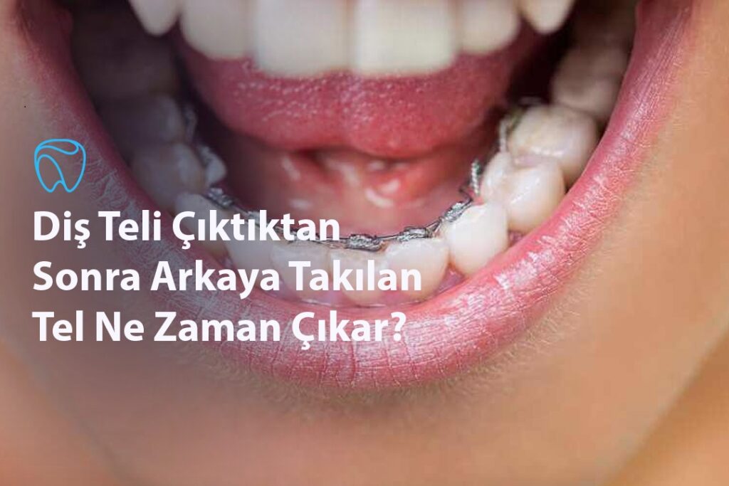 Diş Teli Çıktıktan Sonra Arkaya Takılan Tel Ne Zaman Çıkar Diş Teli Çıktıktan Sonra Arkaya Takılan Tel Ne Zaman Çıkar