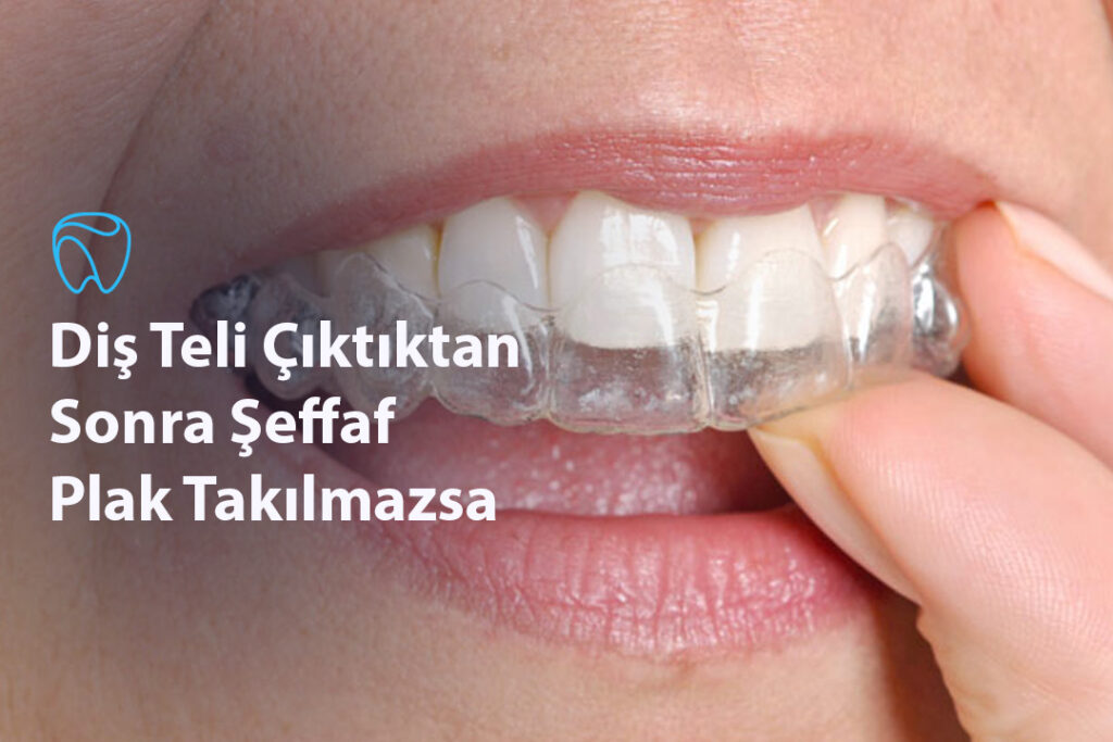 Diş Teli Çıktıktan Sonra Şeffaf Plak Takılmazsa Diş Teli Çıktıktan Sonra Şeffaf Plak Takılmazsa