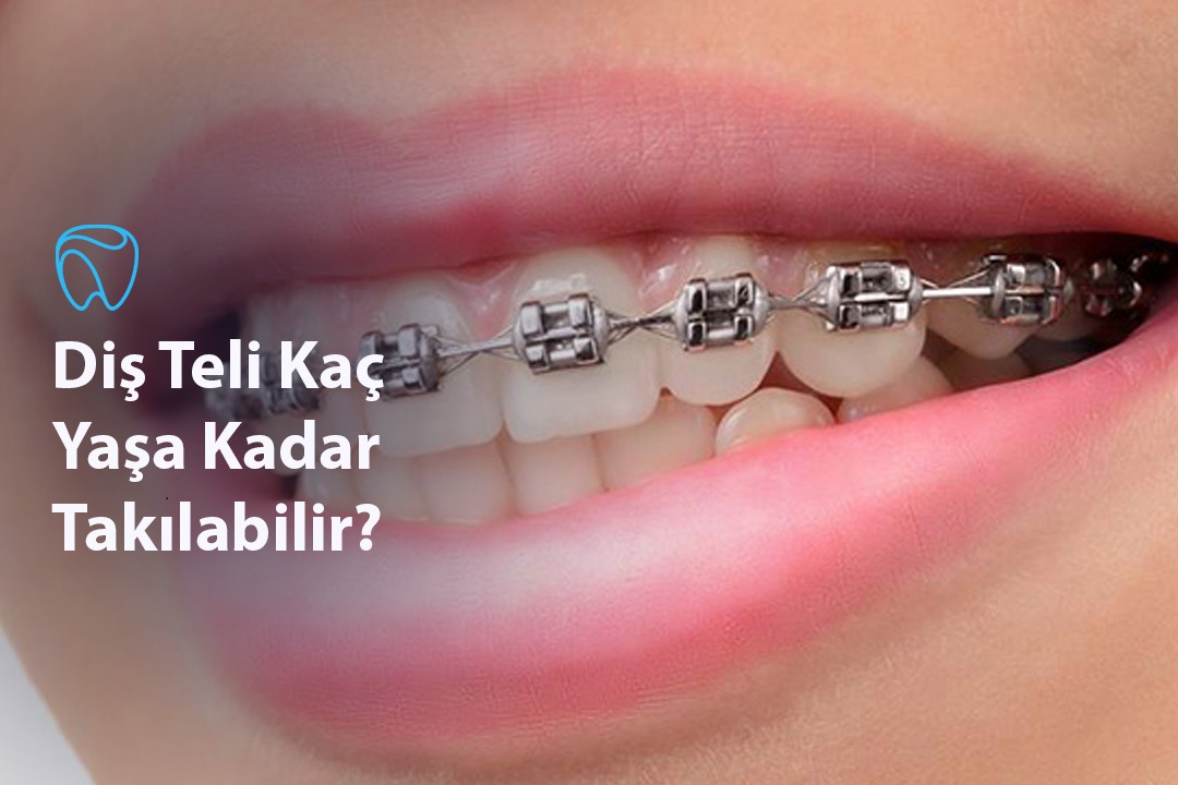 Diş Teli Kaç Yaşa Kadar Takılabilir