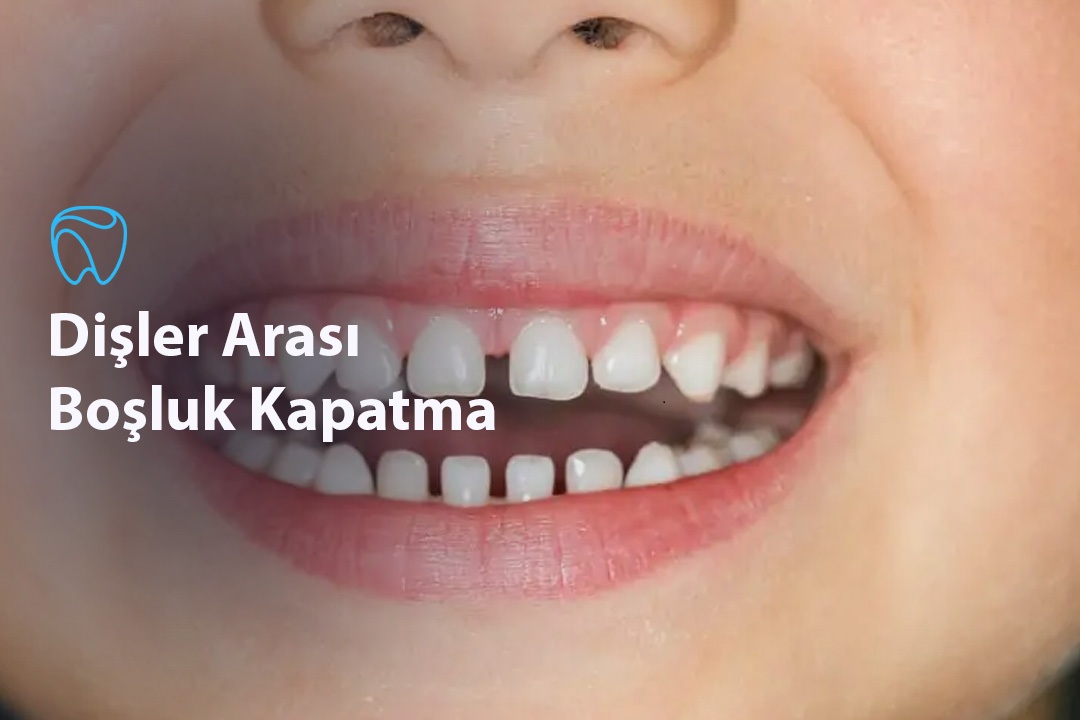 Dişler Arası Boşluk Kapatma