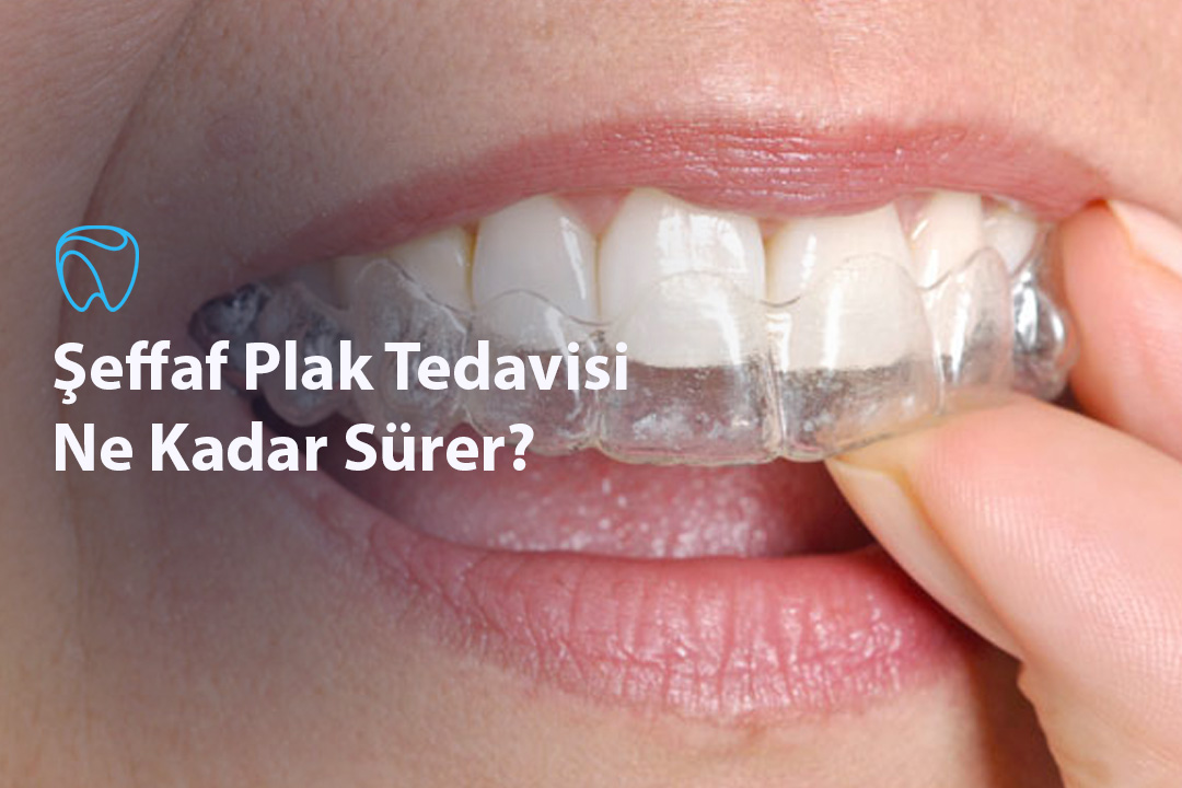 Şeffaf Plak Tedavisi Ne Kadar Sürer